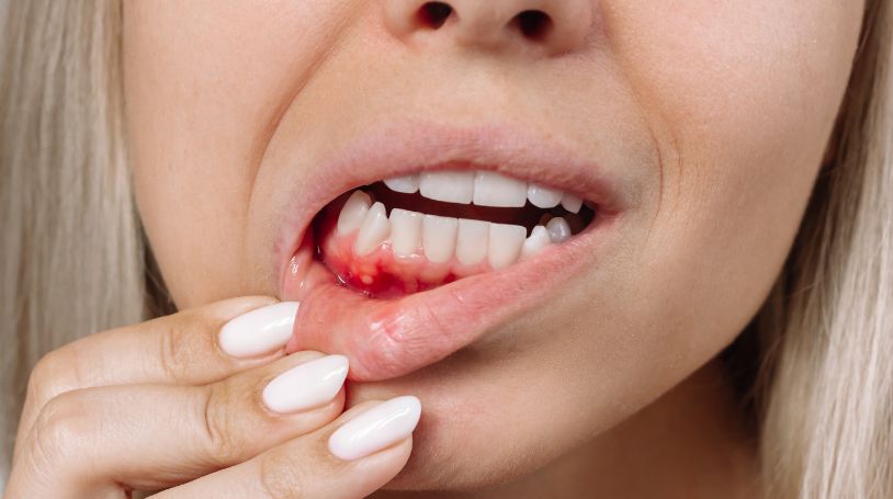 Mouth Ulcers Image