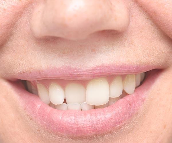 Crooked-and-Misaligned-Teeth-Treatment-in-The-Smile-Place