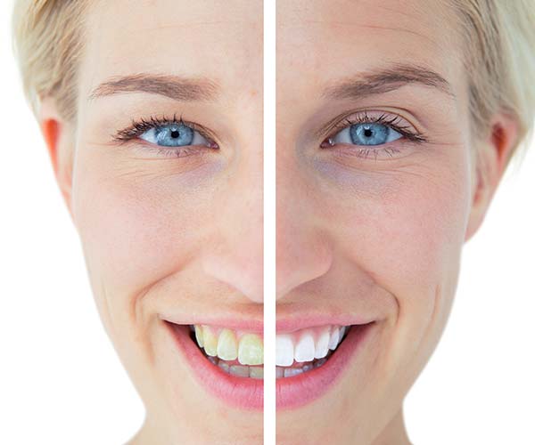 Instant-Teeth-Whitening-Treatment-in-The-Smile-Place