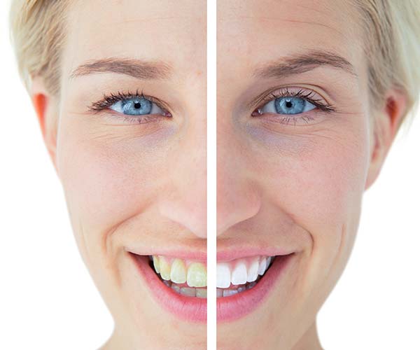 In-chair teeth whitening treatment in progress